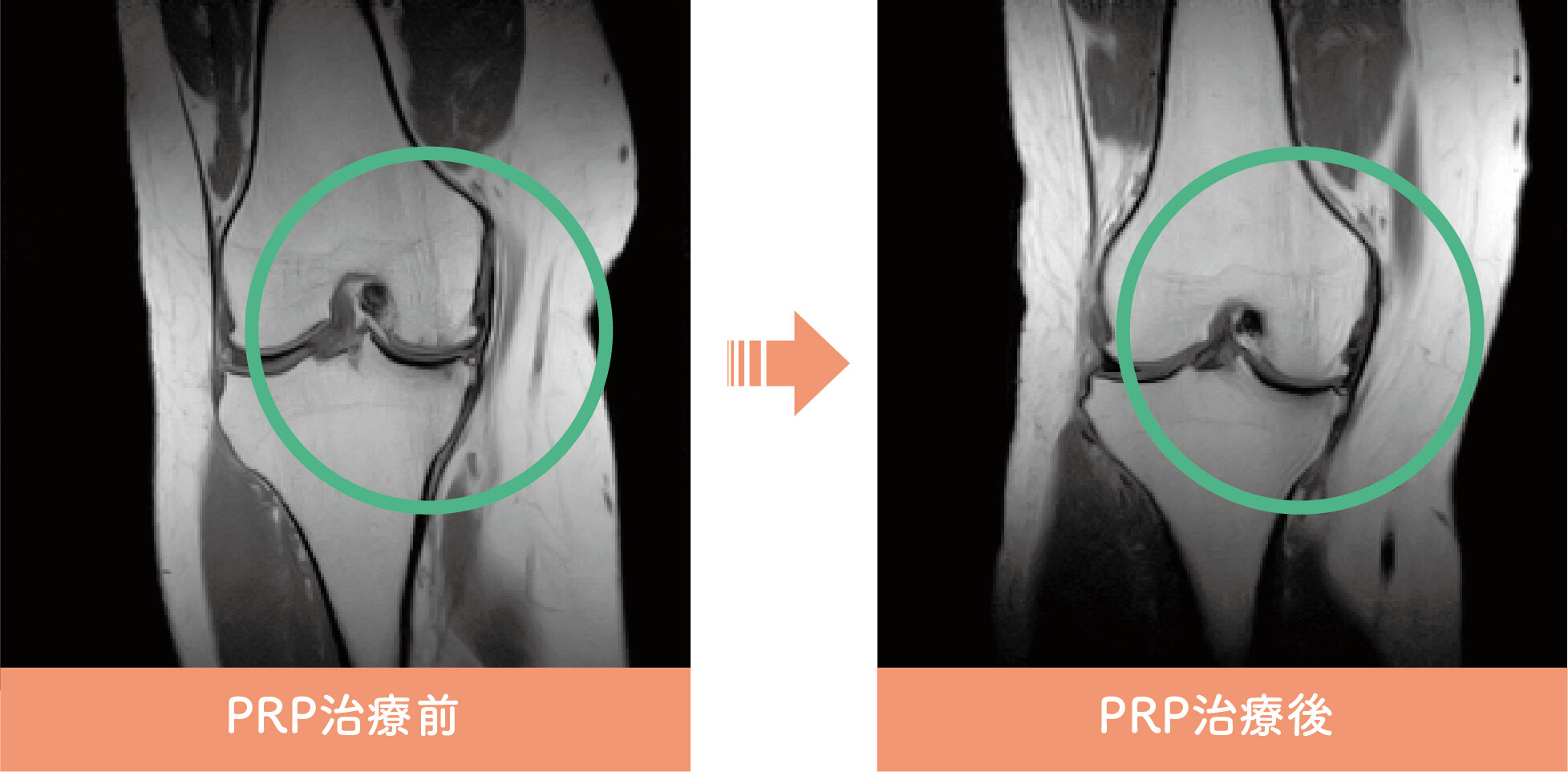 PRP治療前後イメージ