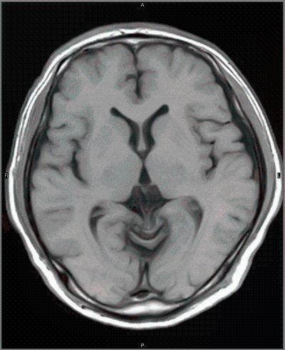 MRIでの脳（脳梗塞、脳出血、脳腫瘍などがわかります）